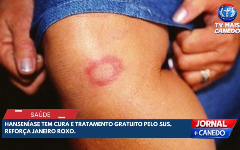 Janeiro Roxo reforça conscientização e combate à hanseníase em Senador Canedo