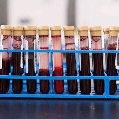 Exame de sangue que rastreia sinais de mais de 50 tipos de câncer chega ao Brasil