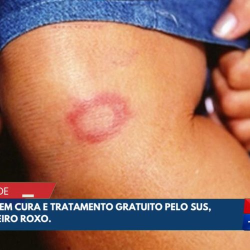 Janeiro Roxo reforça conscientização e combate à hanseníase em Senador Canedo